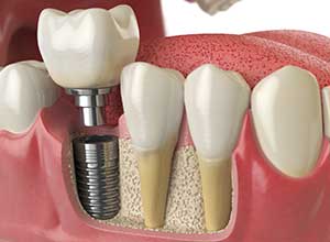 Implantologie - Zahnimplantante